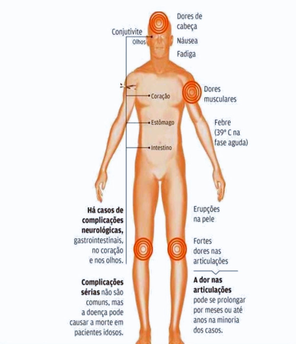 Rancharia registra em maio um caso suspeito de Chikungunya